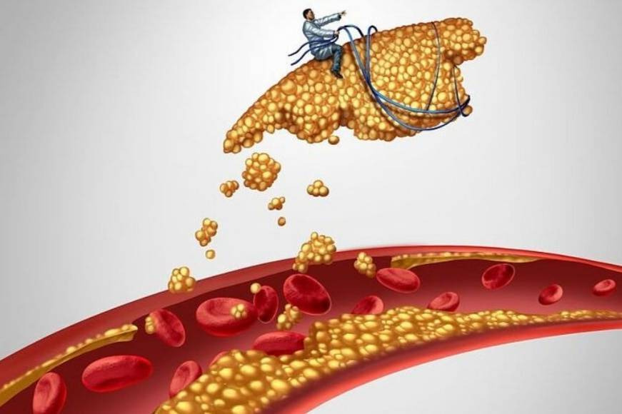 6 Przyczyny wysokiego poziomu cholesterolu, które warto poznać